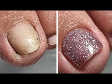Видео: ❤ ПЕДИКЮР на КЛИЕНТЕ ❤ СКРУЧЕННЫЙ ноготь ❤ ЭСТЕТИЧЕСКИЙ педикюр ❤