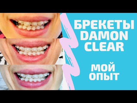 Видео: БРЕКЕТЫ: процесс во всех подробностях. DAMON CLEAR. Путь с идеальной улыбке.