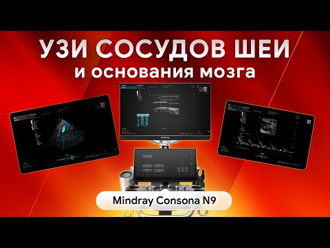 Видео: Возможности Mindray Consona N9 для УЗИ сосудов шеи и основания мозга