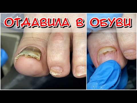 Видео: Отдавила в обуви / Грибок ногтей? А если грибок, что делать? Грибок ногтей / Гематома под ногтем