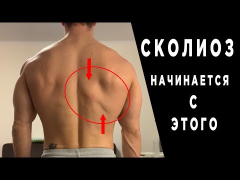 Видео: Исправь ЭТО или начнётся СКОЛИОЗ!!!