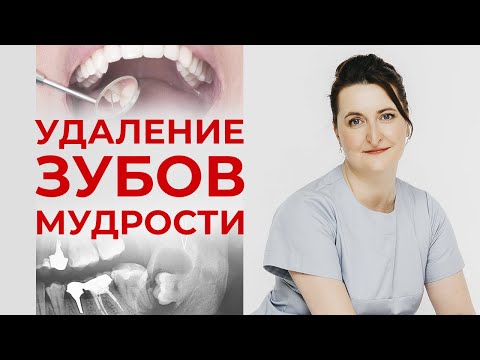 Видео: Удаление зуба мудрости / Интервью со стоматологом-хирургом