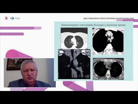 Видео: Первичный рак трахеи - Паршин В.Д.