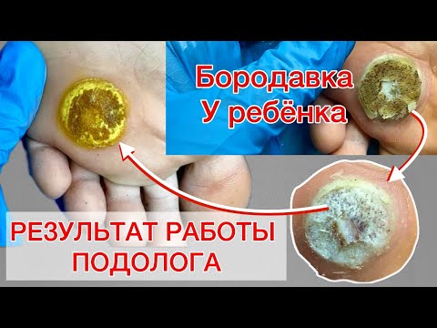 Видео: БОЛЬШАЯ БОРОДАВКА У РЕБЕНКА. КАК УБРАТЬ БОРОДАВКУ? БОРОДАВКА НА СТОПЕ. ЧАСТЬ 2 #алена_лаврентьева