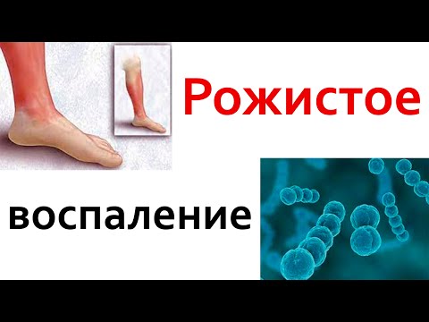 Видео: Все врачи знают этот способ лечения РОЖИСТОГО воспаления. 100% результат