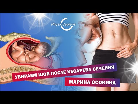 Видео: Убираем шов после кесарева сечения
