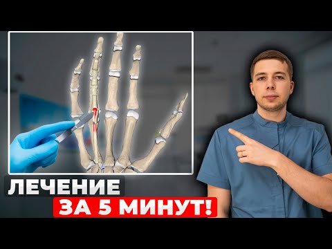 Видео: Как ВЫЛЕЧИТЬ щелкающий палец НАВСЕГДА! Полная процедура лечения!