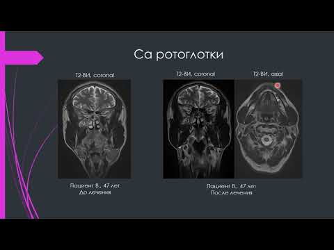 Видео: Семенова М.Д. «МРТ в диагностике и оценке эффективности лучевого лечения опухолей головы и шеи»