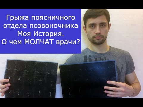 Видео: Грыжа поясничного отдела позвоночника. Моя история лечения.