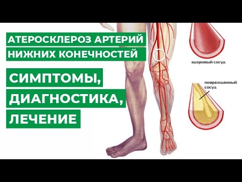 Видео: Атеросклероз артерий нижних конечностей, симптомы, диагностика, лечение.