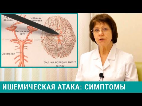 Видео: Ишемическая атака головного мозга: симптомы. Как мы лечим ишемические атаки