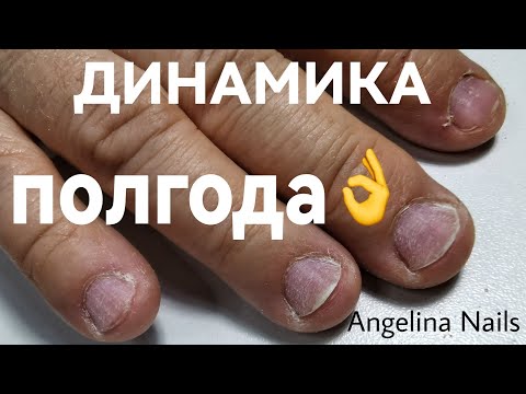 Видео: ДИНАМИКА маникюра  сложных ногтей / короткое ногтевое ложе /  трамплины  укрепление гелем