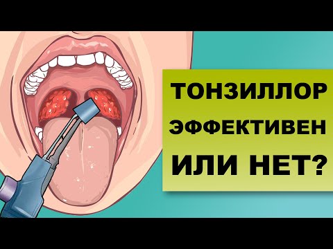 Видео: ПОМОЖЕТ ЛИ МНЕ ТОНЗИЛЛОР? Все о промывании миндалин