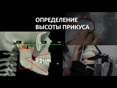 Видео: ОПРЕДЕЛЕНИЕ ВЫСОТЫ ПРИКУСА И ГИПСОВКА В НОЛЬ