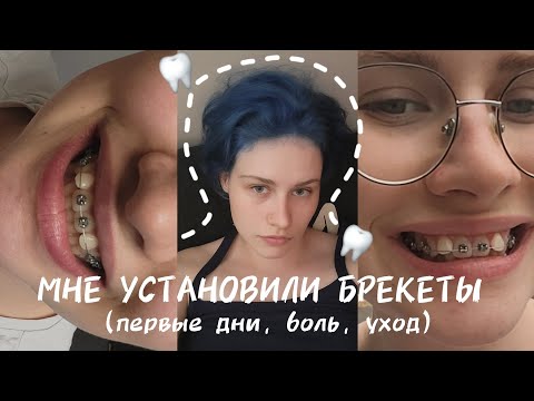 Видео: мне поставили брекеты | первые дни | уход и ощущения | брекеты моя история