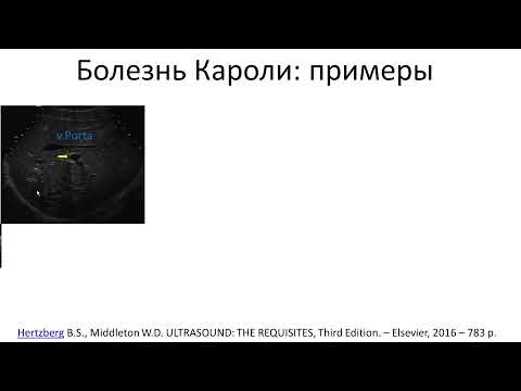 Видео: Кисты  общего желчного протока. Болезнь Кароли