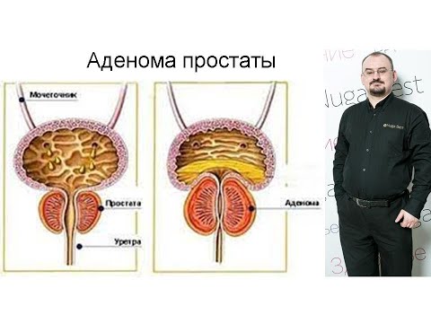 Видео: Как лечить аденому простаты?