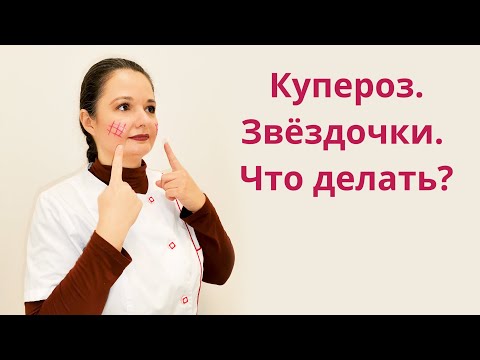 Видео: Купероз на лице — от чего образуется и как его убрать