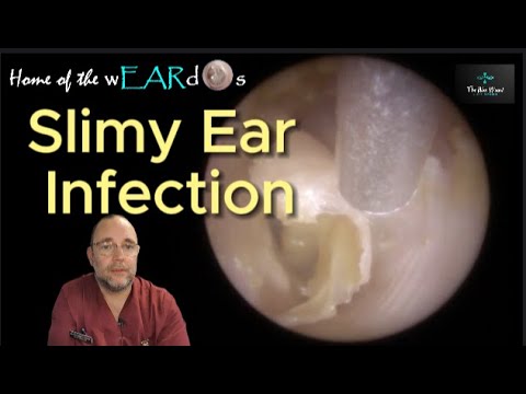 Видео: ИНФЕКЦИЯ СЛИЗИСТОГО УША 225 #ухо #ушнаясера #удалениеушнойсеры #чисткаушей #асмр #асмрушнаясера #...