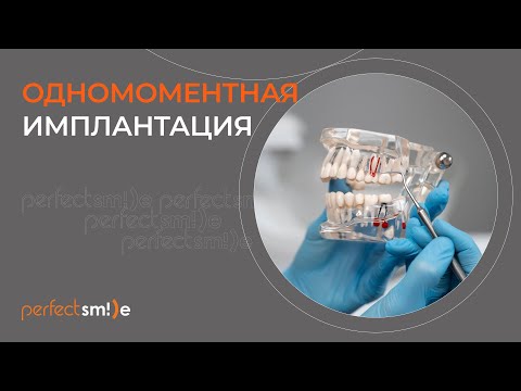 Видео: 🔎​🦷​ Одномоментная имплантация