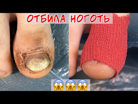 Видео: Ушиб пальца ноги / Отбила ноготь об диван
