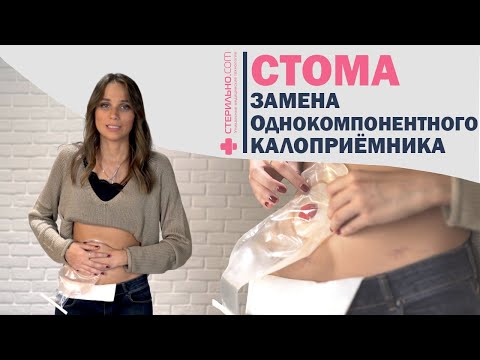 Видео: Как заменить однокомпонентный калоприемник для стомы?  | Стерильно.com