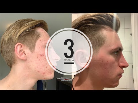 Видео: РОАККУТАН | 3 мес | Моя история, как я избавился от прыщей