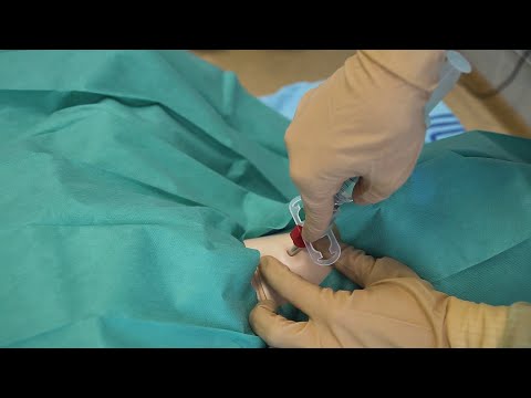 Видео: Пункционная коникотомия без проводника набором Quick Trach I