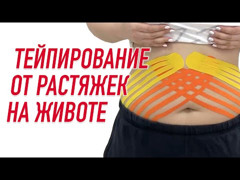 Видео: ✅ ТЕЙПИРОВАНИЕ ОТ РАСТЯЖЕК НА ЖИВОТЕ |. Валентин Гайт | Учебный центр BBALANCE