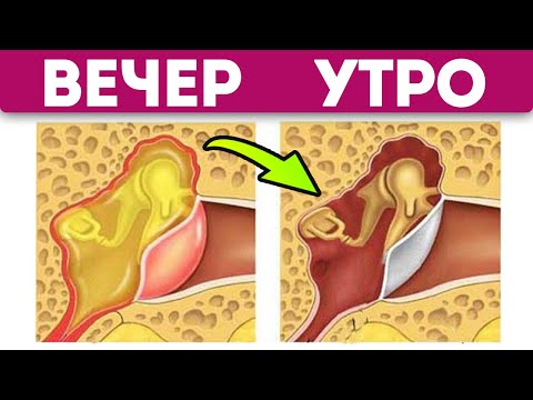 Видео: Отит сам себя растворяет, после домашних средств. Лечение отита