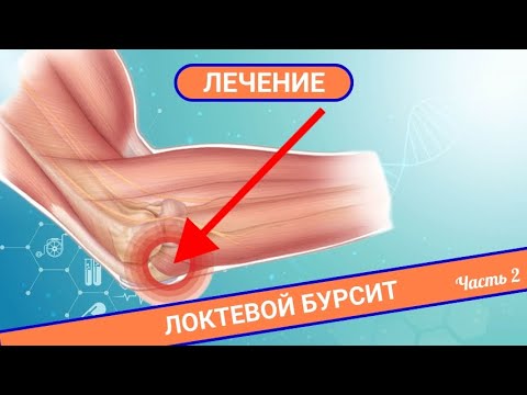 Видео: КАК ВЫЛЕЧИТЬ БОЛЬ В ЛОКТЕ? | Локтевой бурсит (Часть 2)