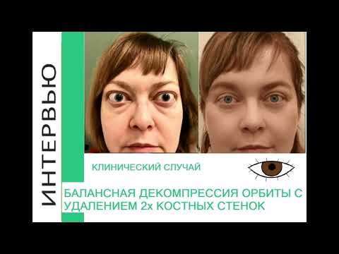 Видео: Проект "Назад в будущее". Результат лечения. Случай № 2. Эндокринная офтальмопатия.