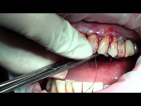 Видео: Полная версия. Мария Александровна Носова. Устранение рецессии по методу Зуккелли. Эпизод 3.