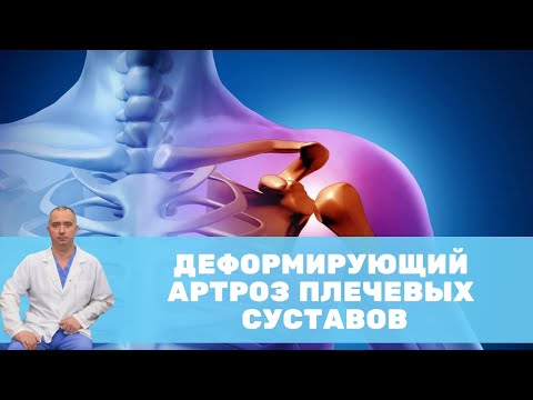 Видео: Деформирующий артроз плечевых суставов