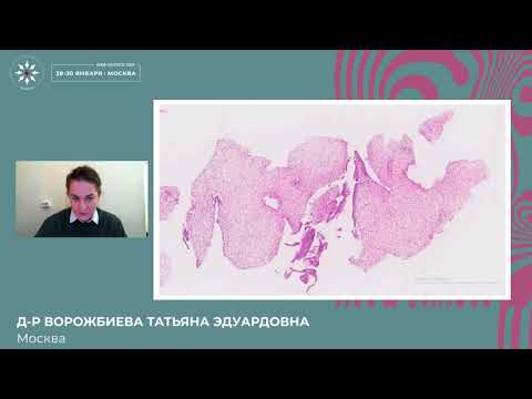 Видео: Дифференциальная диагностика фиброэпителиальных опухолей молочной железы и метапластического РМЖ