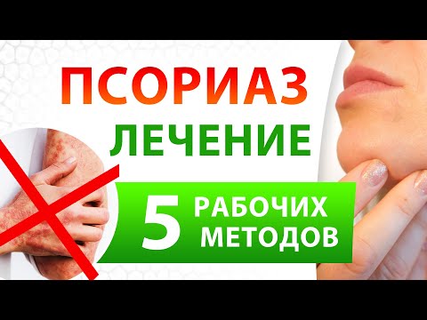 Видео: Как я ВЫЛЕЧИЛ ПСОРИАЗ! 5 проверенных методов ЛЕЧЕНИЯ ПСОРИАЗА
