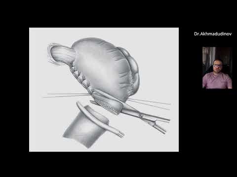 Видео: Резекция желудка по Бильрот 1 (Гастродуоденостомия)