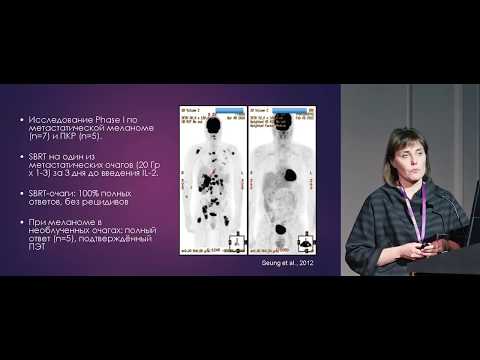 Видео: Диссеминированная меланома: есть ли место комбинации лучевой терапии с ИКТ