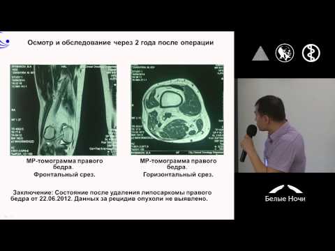 Видео: Эмболизация сосудов и криовоздействие в лечении рецидивирующей саркомы мягких тканей правого бедра