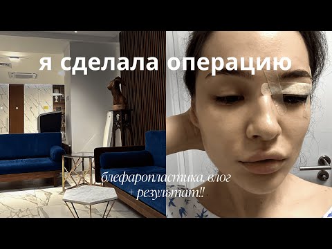 Видео: БЛЕФАРОПЛАСТИКА: моя история, птоз века