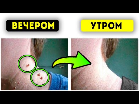 Видео: Вывалятся с корнем! Папилломы, бородавки и кондиломы уничтожит раствор копеечной…