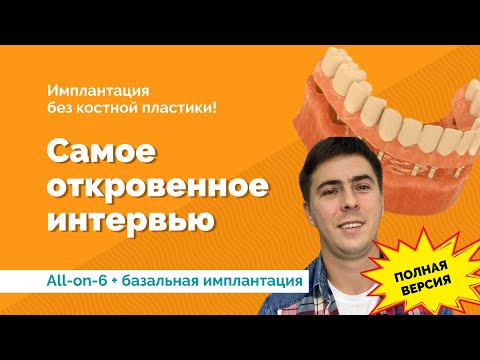 Видео: Все на 6 и базальная имплантация. Отзыв пациента подробный