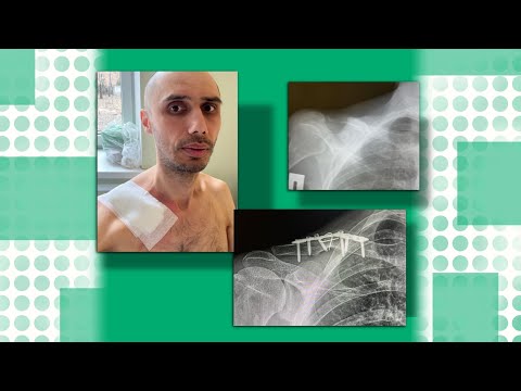 Видео: Перелом Ключицы | Удаление Пластины