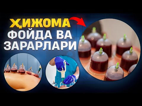 Видео: Ҳижома. Фойда ва зарарлари | Доктор Гулбаҳор