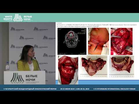 Видео: Обоснование хирургического подхода к лечению рецидивов (Ребрикова И.В.)