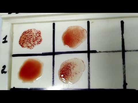 Видео: Сross blood group/ГРУППА КРОВИ. КАК ОПРЕДЕЛИТЬ ПЕРЕКРЁСТНЫМ МЕТОДОМ