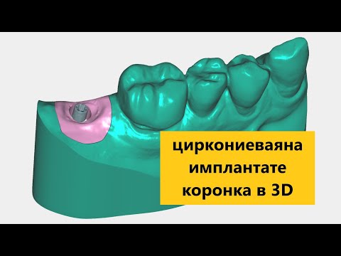 Видео: Циркониевая коронка на импланте. Моделируем в EXOCAD. Exocad crown design