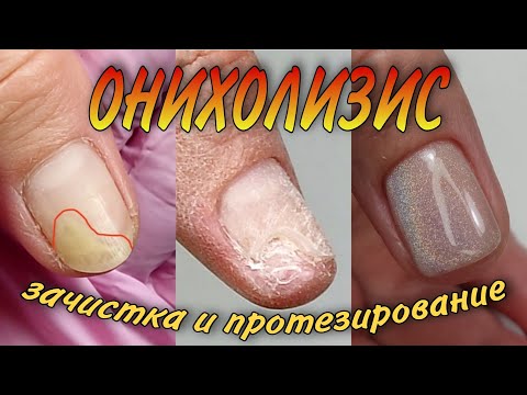 Видео: онихолизис\зачистка и протезирование