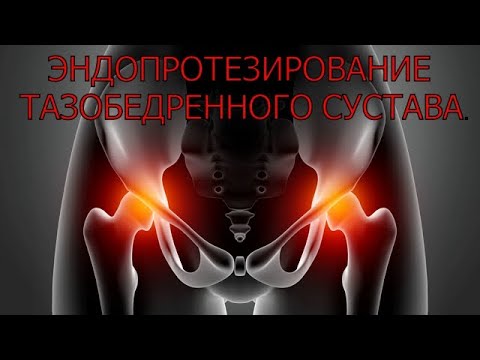 Видео: Эндопротезирование сустава - делать или нет!