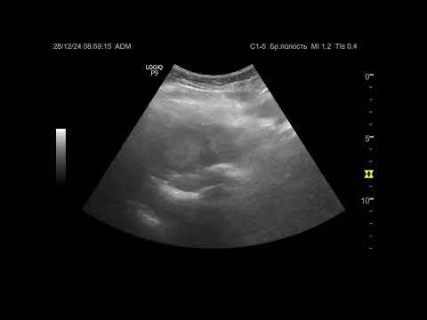 Видео: Ультразвуковая диагностика. Доктор Иогансен. Видеопримеры. Выпуск 110. Метастазы в печени (3).